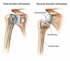 Shoulder Surgery, shoulder treatment recovery, shoulder treatment doctor in Pune